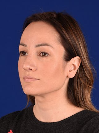 Female Rhinoplasty Before & After Gallery - Patient 122143797 - Image 4