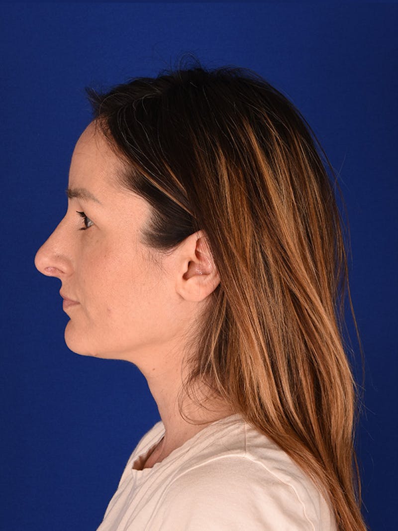 Female Rhinoplasty Before & After Gallery - Patient 122143797 - Image 5