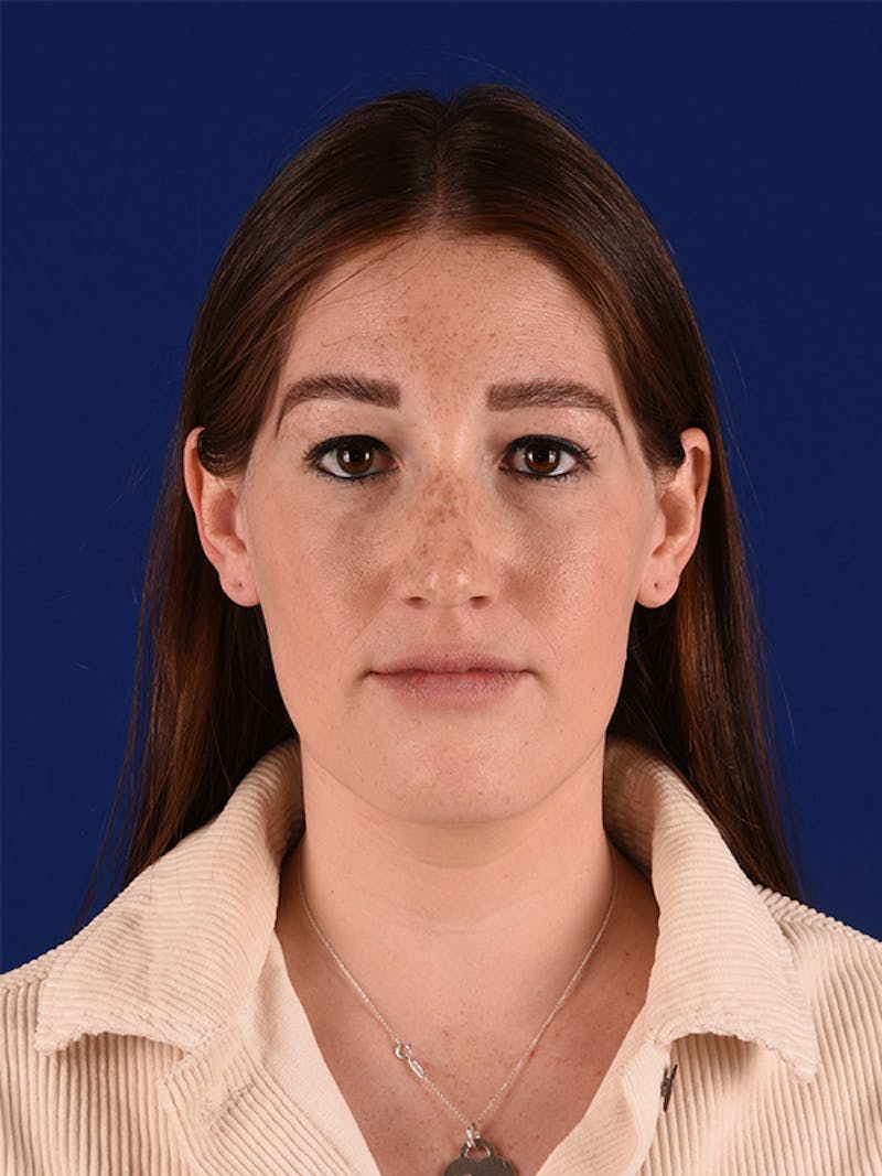 Female Rhinoplasty Before & After Gallery - Patient 122144577 - Image 1