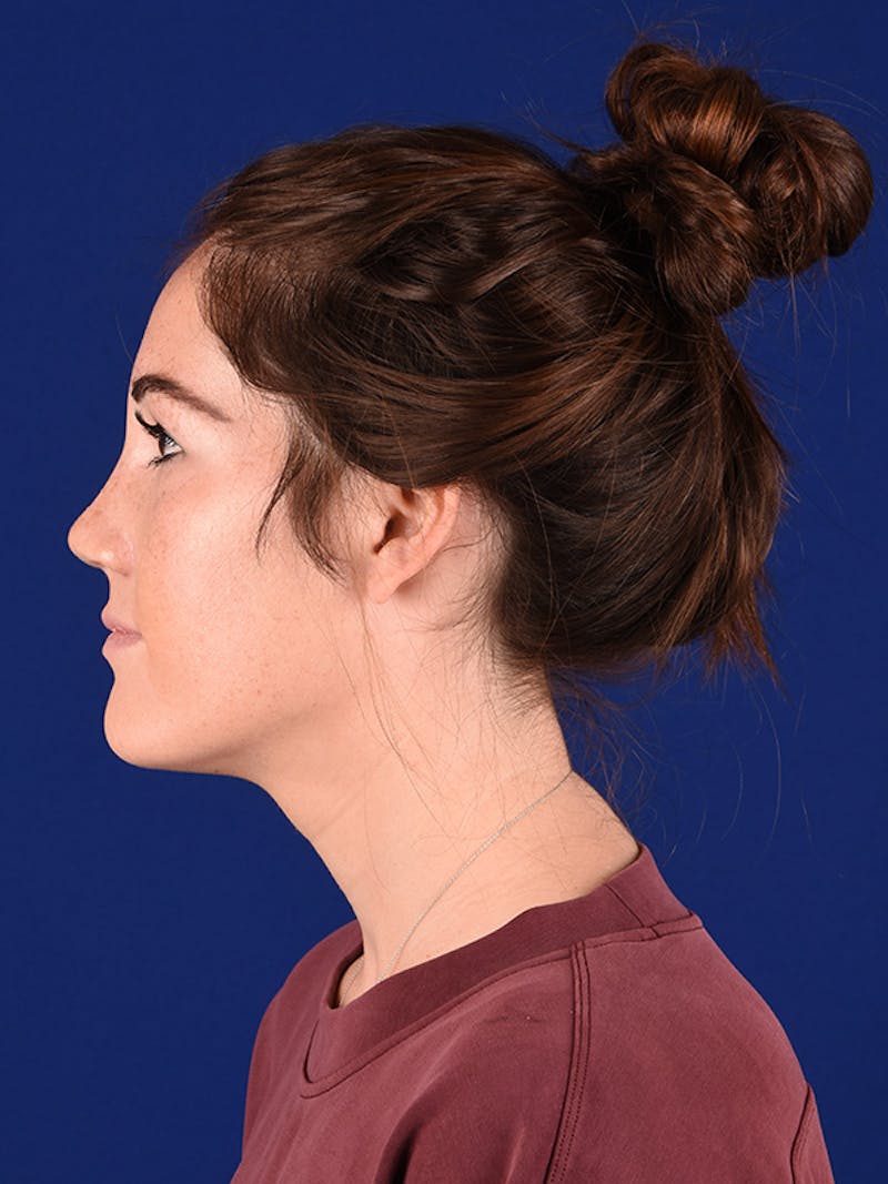 Female Rhinoplasty Before & After Gallery - Patient 122144577 - Image 6
