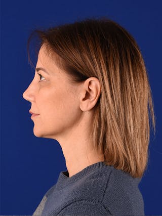 Female Rhinoplasty Before & After Gallery - Patient 122144611 - Image 6