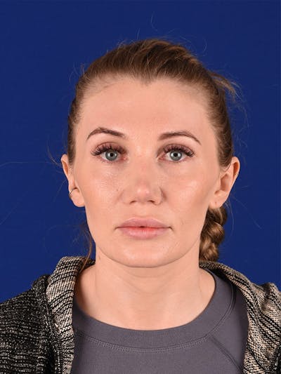 Female Rhinoplasty Before & After Gallery - Patient 122144657 - Image 2