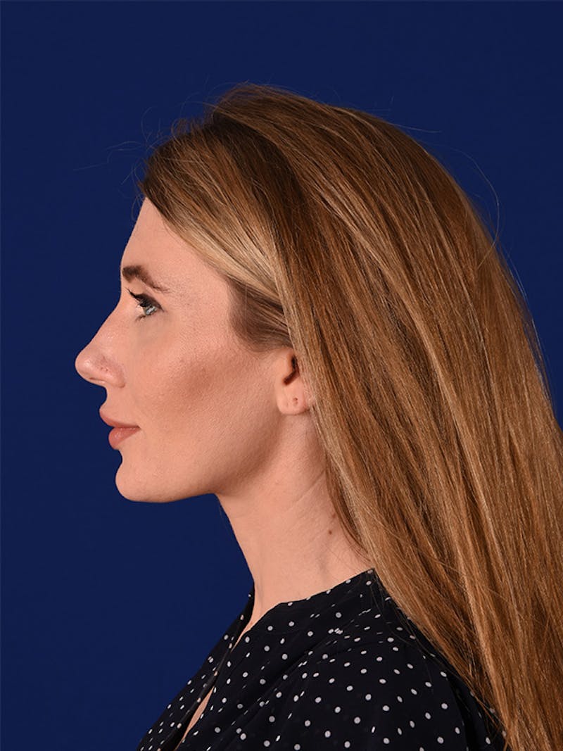Female Rhinoplasty Before & After Gallery - Patient 122144657 - Image 5