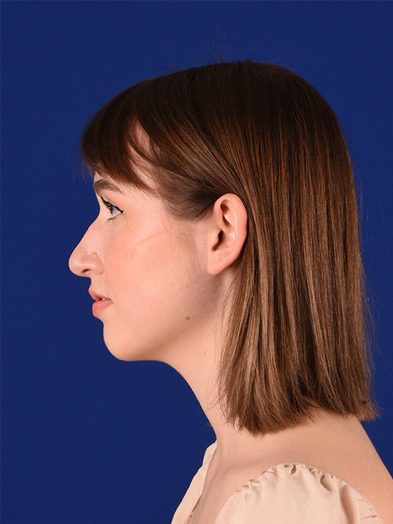 Female Rhinoplasty Before & After Gallery - Patient 122144703 - Image 3