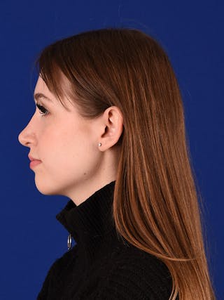 Female Rhinoplasty Before & After Gallery - Patient 122144703 - Image 4