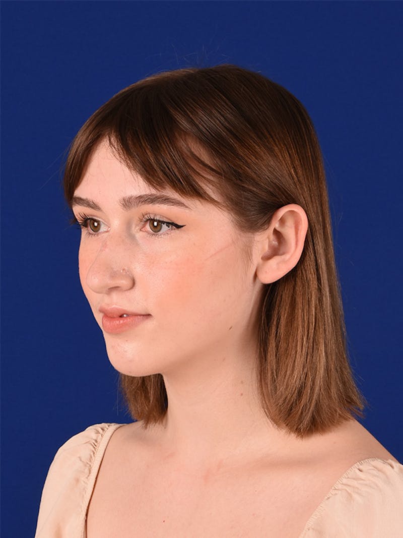 Female Rhinoplasty Before & After Gallery - Patient 122144703 - Image 5
