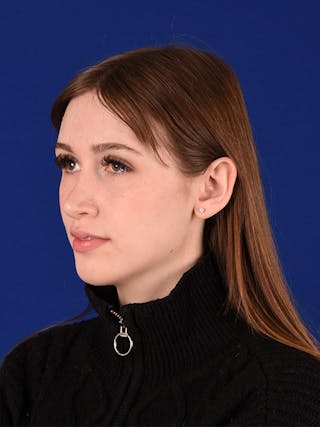 Female Rhinoplasty Before & After Gallery - Patient 122144703 - Image 6