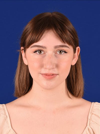 Female Rhinoplasty Before & After Gallery - Patient 122144703 - Image 1