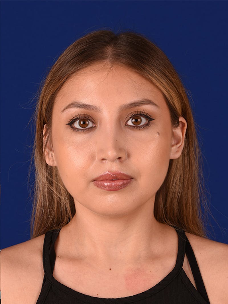 Female Rhinoplasty Before & After Gallery - Patient 122144734 - Image 2