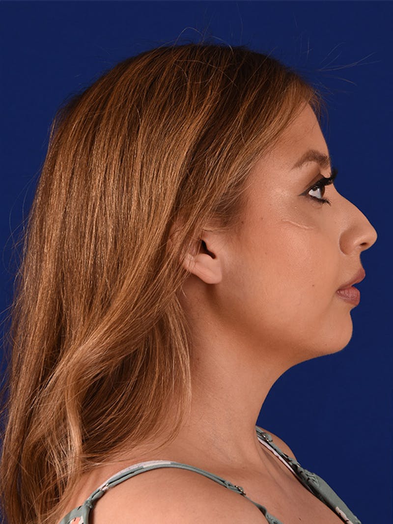 Female Rhinoplasty Before & After Gallery - Patient 122144734 - Image 3