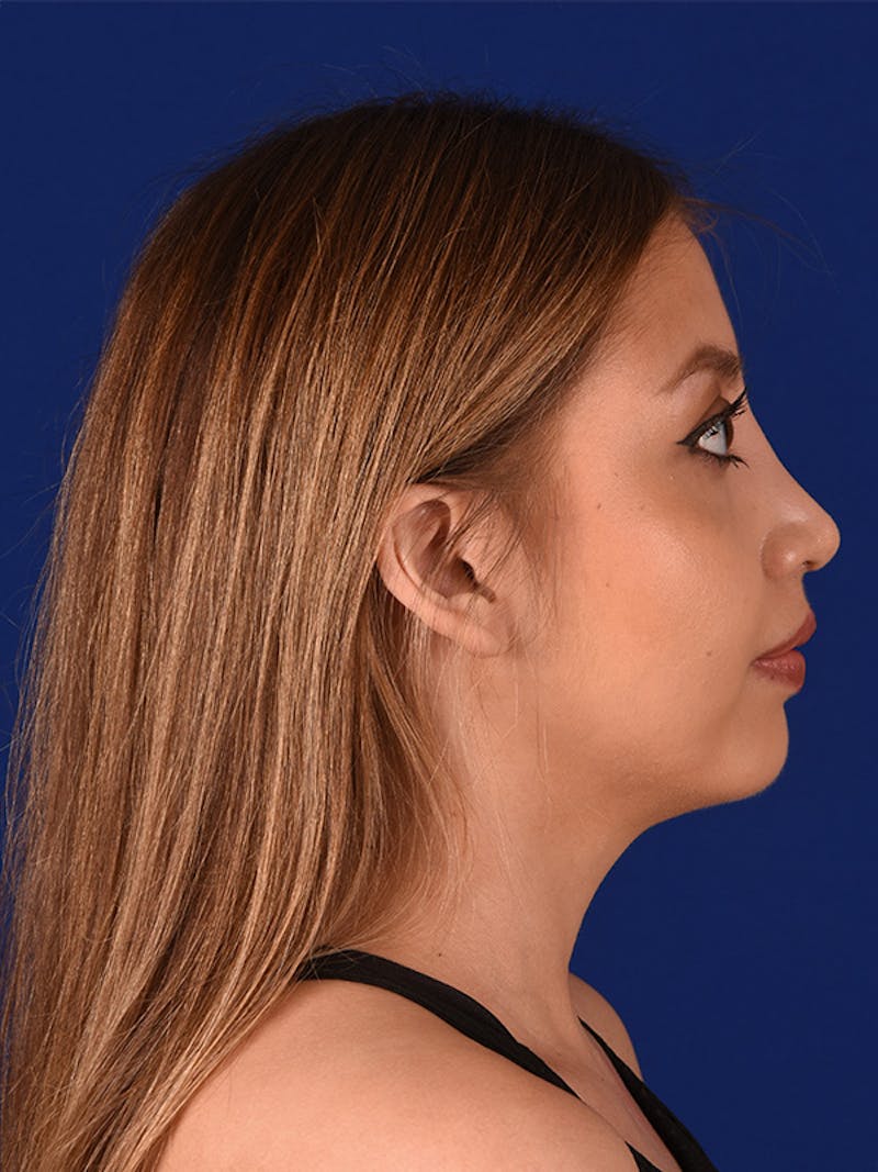 Female Rhinoplasty Before & After Gallery - Patient 122144734 - Image 4
