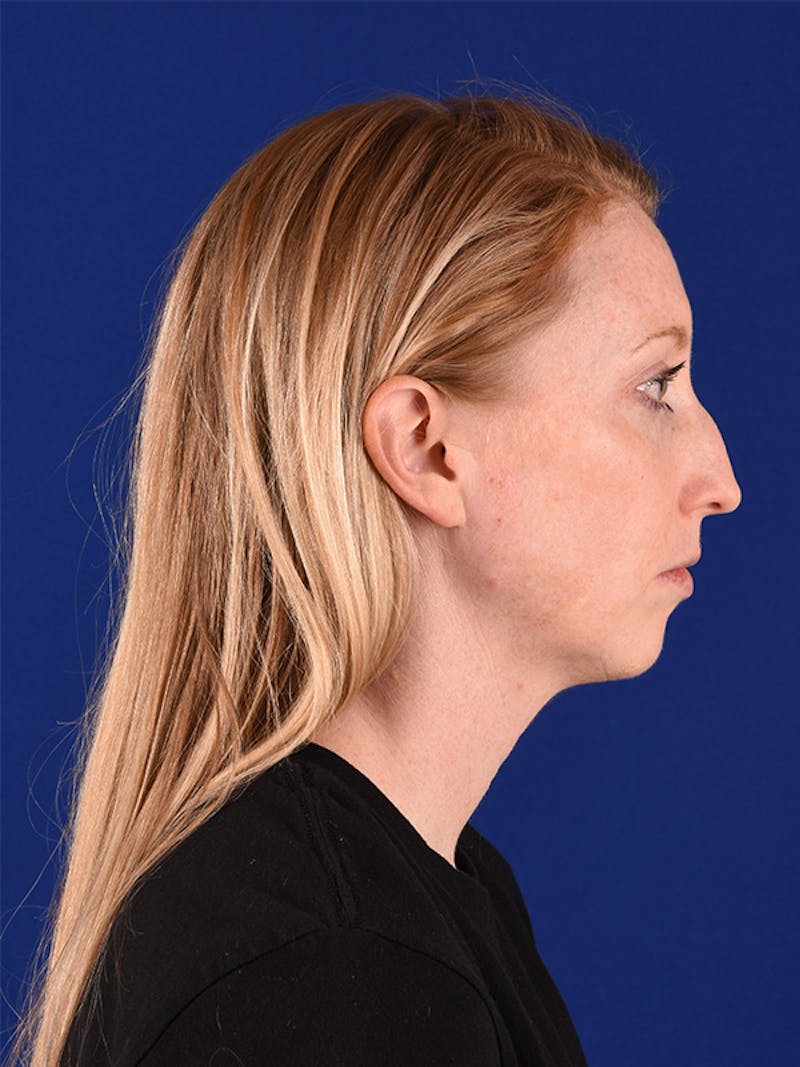 Female Rhinoplasty Before & After Gallery - Patient 122144756 - Image 5