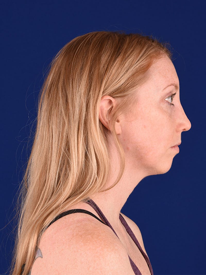 Female Rhinoplasty Before & After Gallery - Patient 122144756 - Image 6