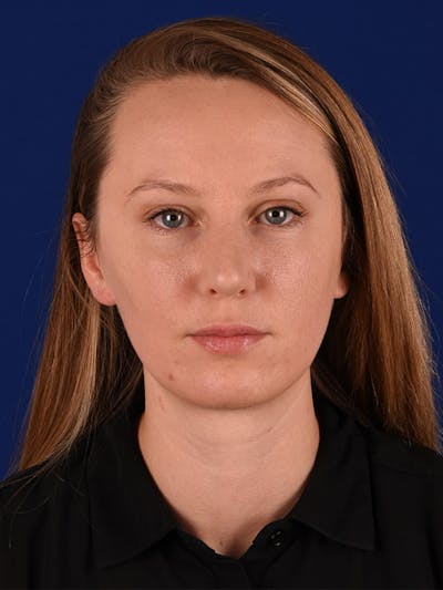Female Rhinoplasty Before & After Gallery - Patient 122144807 - Image 2
