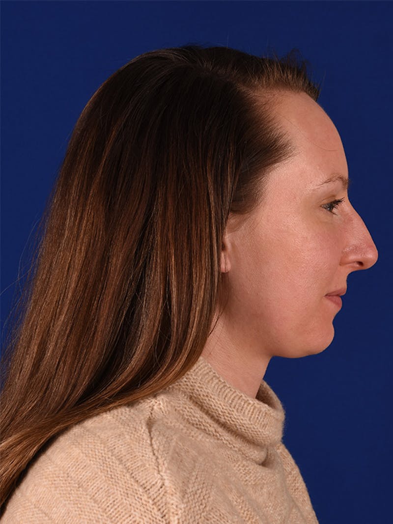 Female Rhinoplasty Before & After Gallery - Patient 122144807 - Image 5