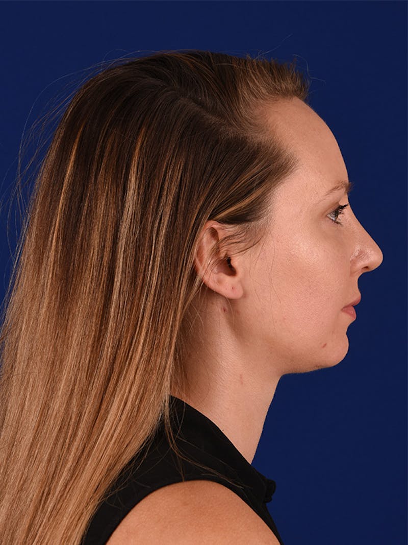 Female Rhinoplasty Before & After Gallery - Patient 122144807 - Image 6