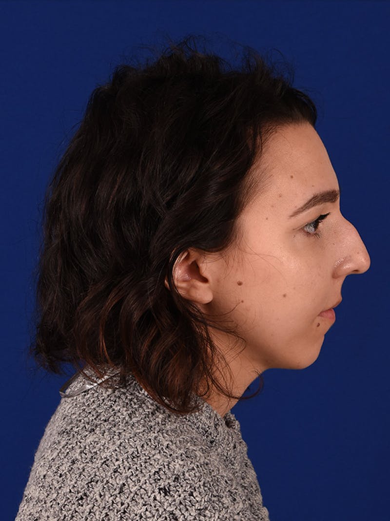 Chin Augmentation Before & After Gallery - Patient 122146106 - Image 5