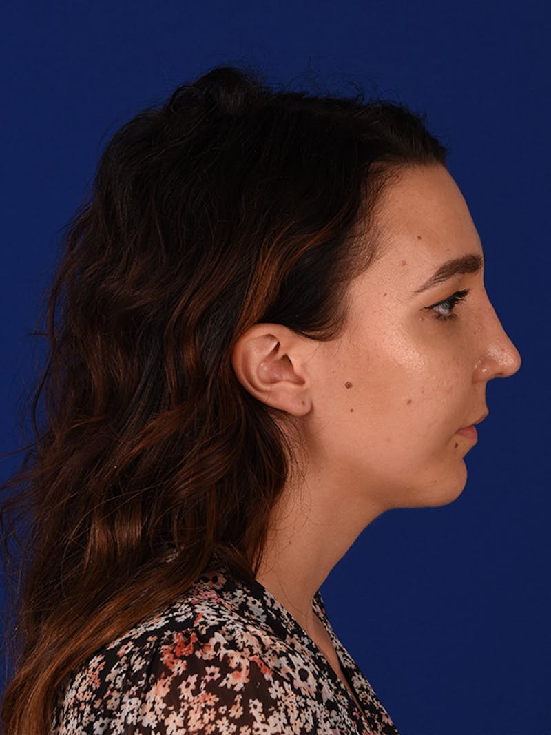 Chin Augmentation Before & After Gallery - Patient 122146106 - Image 6