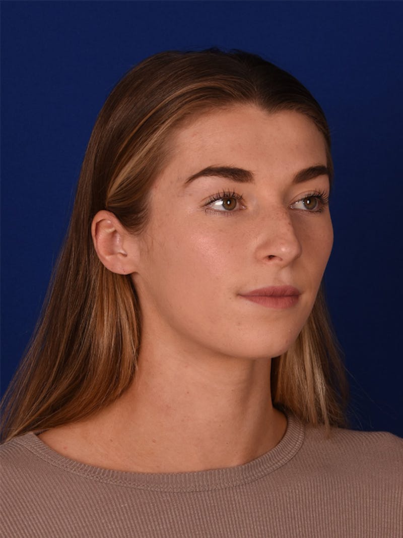 Female Rhinoplasty Before & After Gallery - Patient 122144885 - Image 3