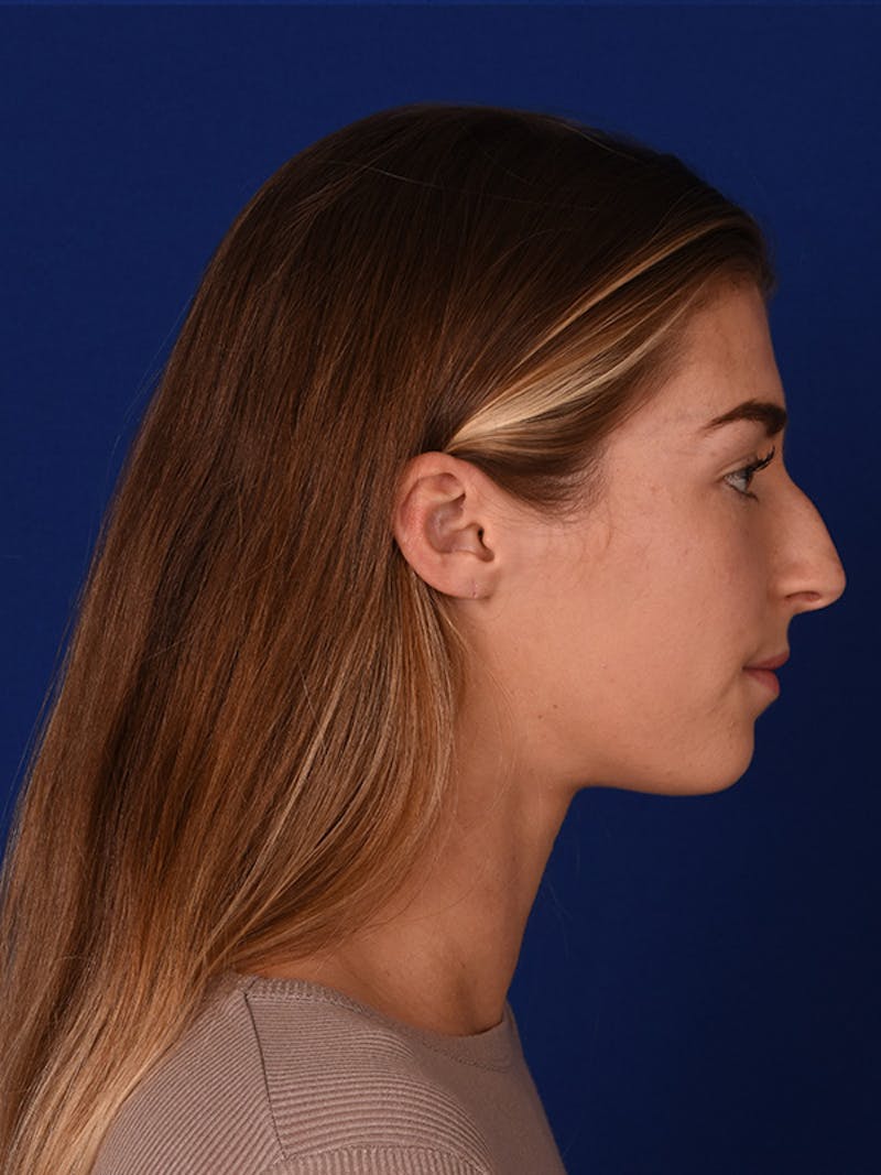 Female Rhinoplasty Before & After Gallery - Patient 122144885 - Image 5
