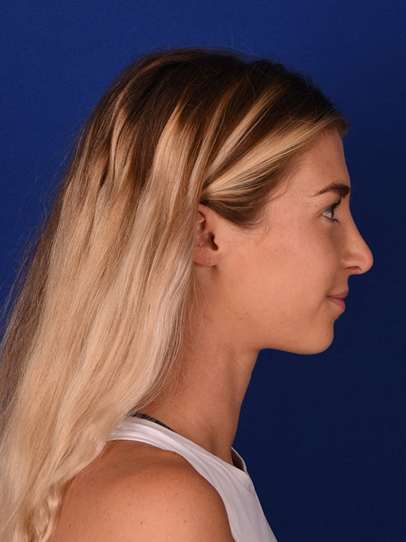 Female Rhinoplasty Before & After Gallery - Patient 122144885 - Image 6
