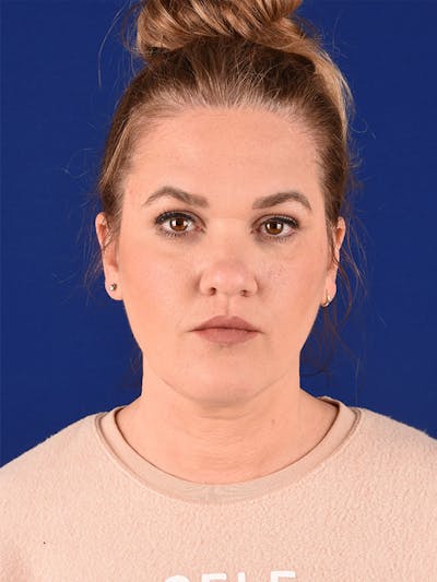 Female Rhinoplasty Before & After Gallery - Patient 122144936 - Image 1
