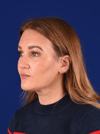 Brow Lift Before & After Gallery - Patient 122146551 - Image 4