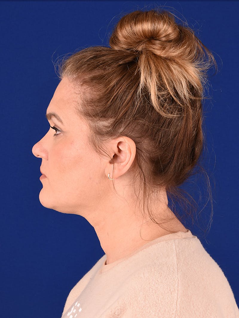 Female Rhinoplasty Before & After Gallery - Patient 122144936 - Image 5