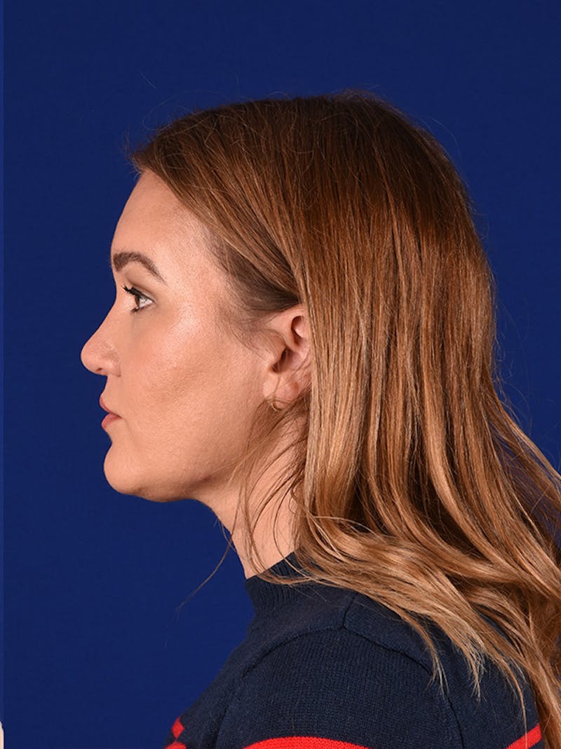 Female Rhinoplasty Before & After Gallery - Patient 122144936 - Image 6