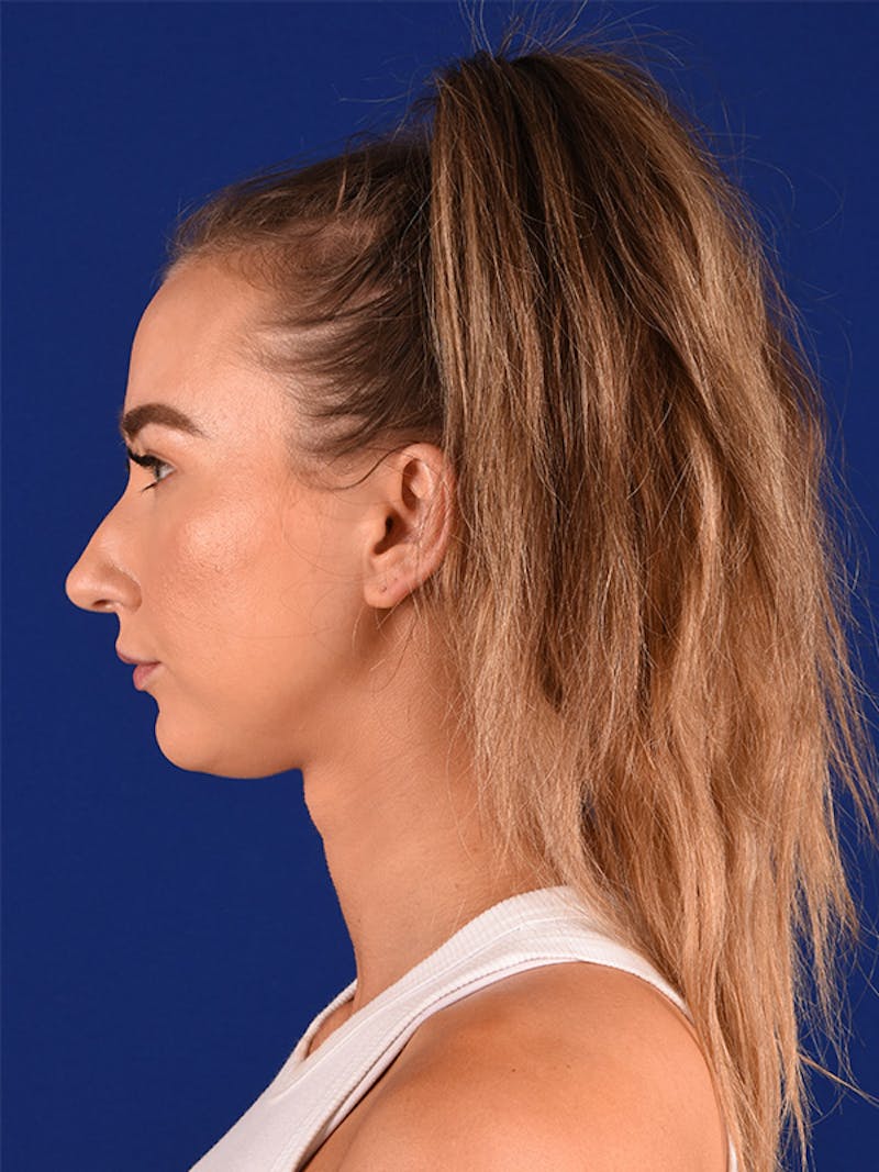 Female Rhinoplasty Before & After Gallery - Patient 122144969 - Image 3