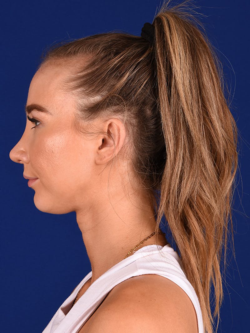 Female Rhinoplasty Before & After Gallery - Patient 122144969 - Image 4