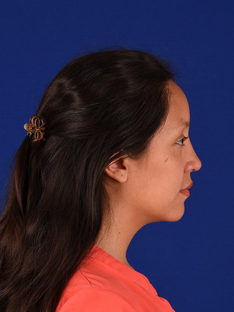 Female Rhinoplasty Before & After Gallery - Patient 122145009 - Image 6