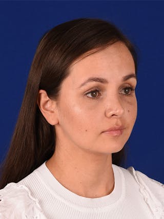 Female Rhinoplasty Before & After Gallery - Patient 122145050 - Image 4