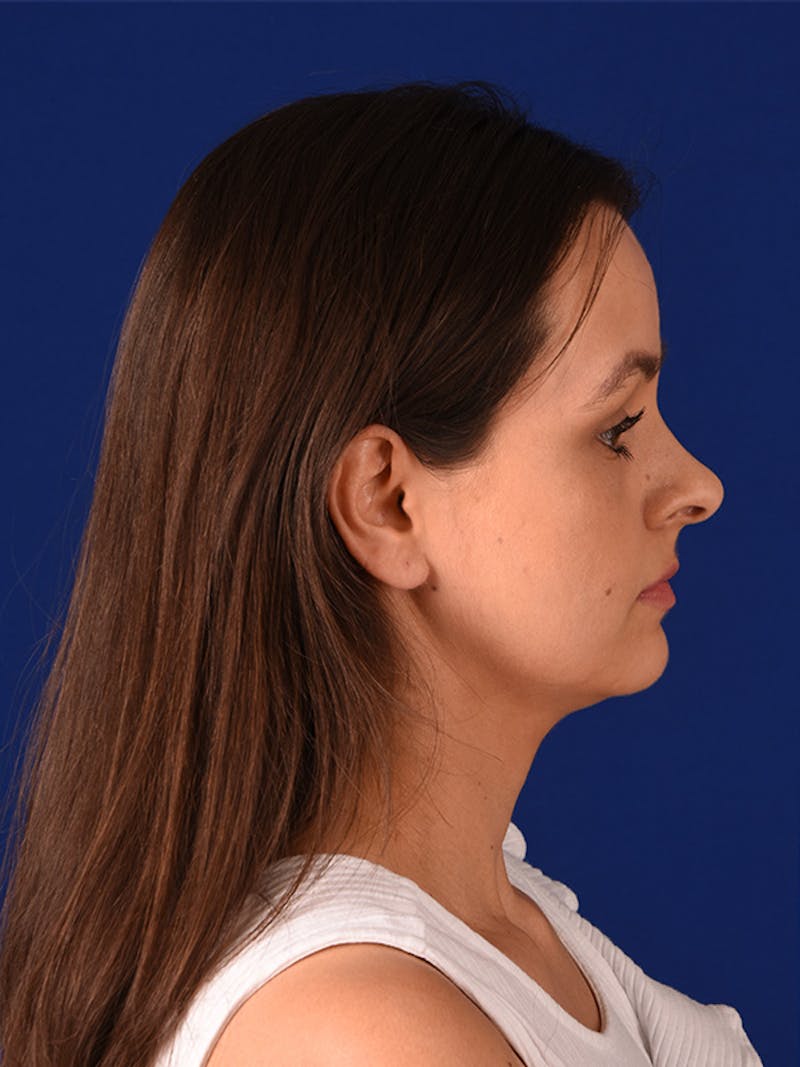 Female Rhinoplasty Before & After Gallery - Patient 122145050 - Image 5