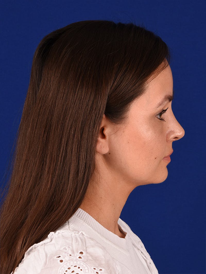 Female Rhinoplasty Before & After Gallery - Patient 122145050 - Image 6