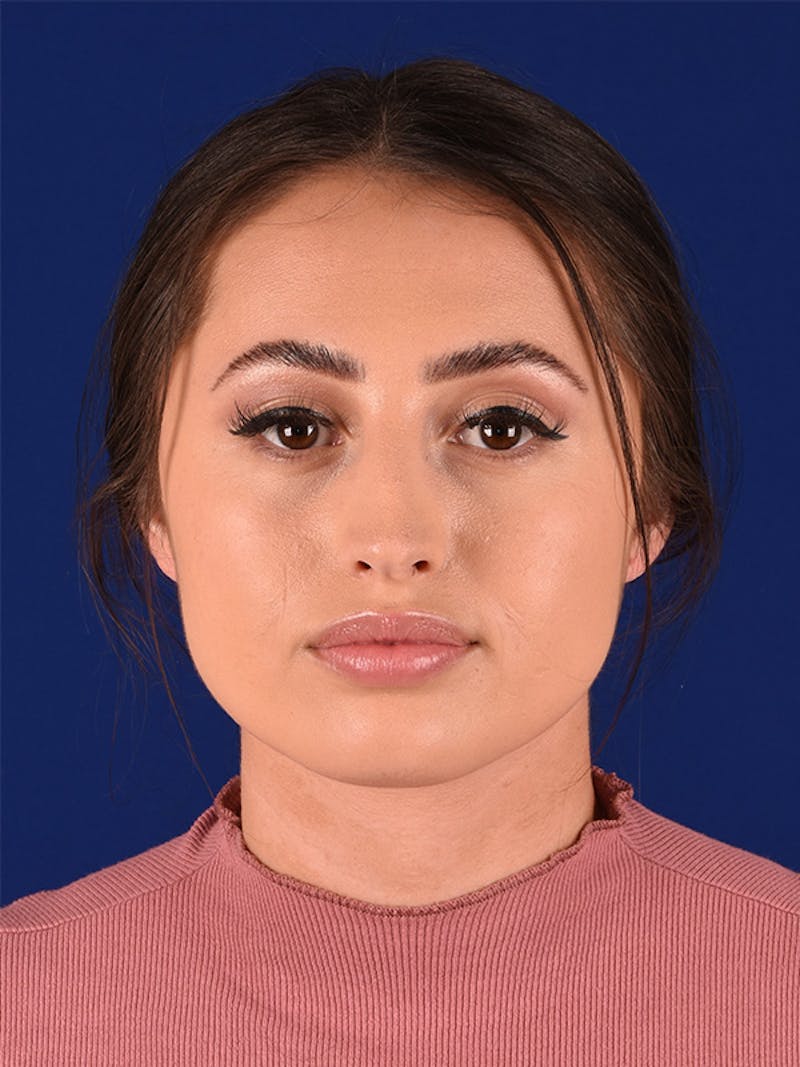 Female Rhinoplasty Before & After Gallery - Patient 122145092 - Image 1