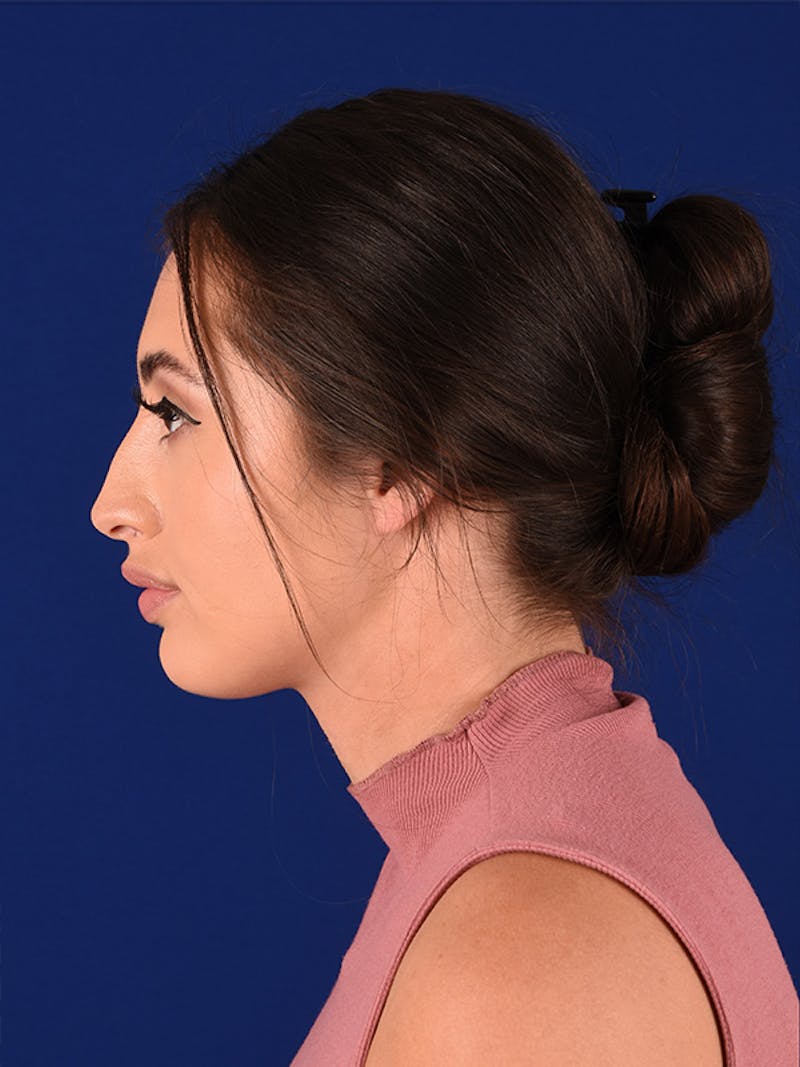 Female Rhinoplasty Before & After Gallery - Patient 122145092 - Image 5