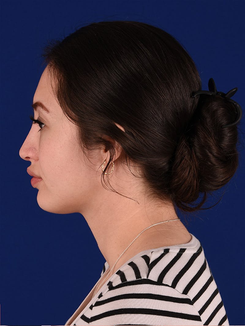 Female Rhinoplasty Before & After Gallery - Patient 122145092 - Image 6
