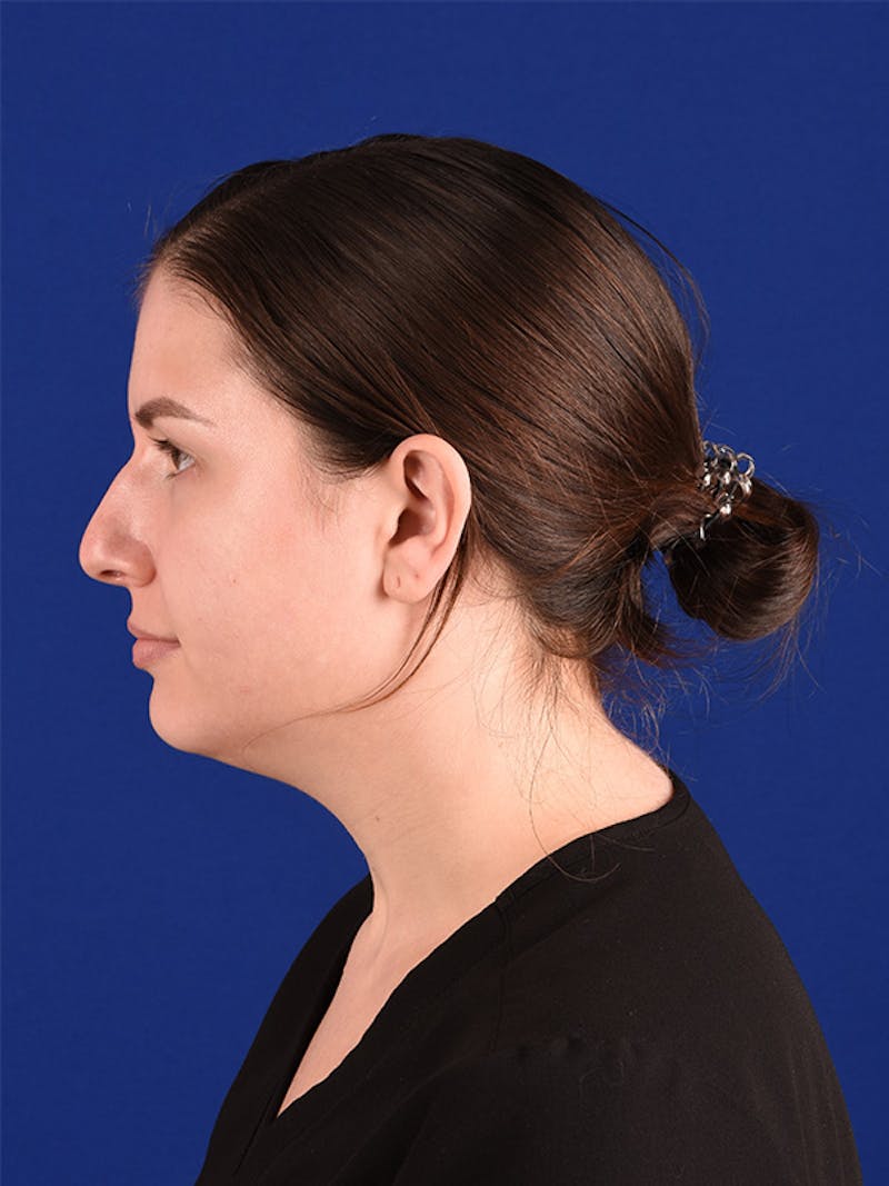 Female Rhinoplasty Before & After Gallery - Patient 122145131 - Image 5