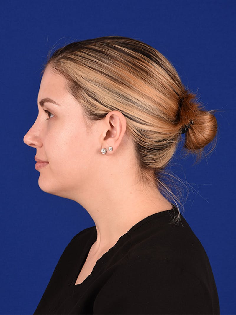 Female Rhinoplasty Before & After Gallery - Patient 122145131 - Image 6