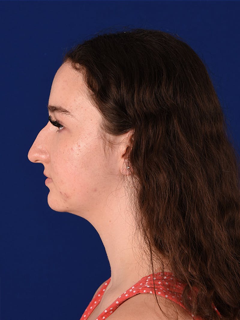 Female Rhinoplasty Before & After Gallery - Patient 122145159 - Image 3