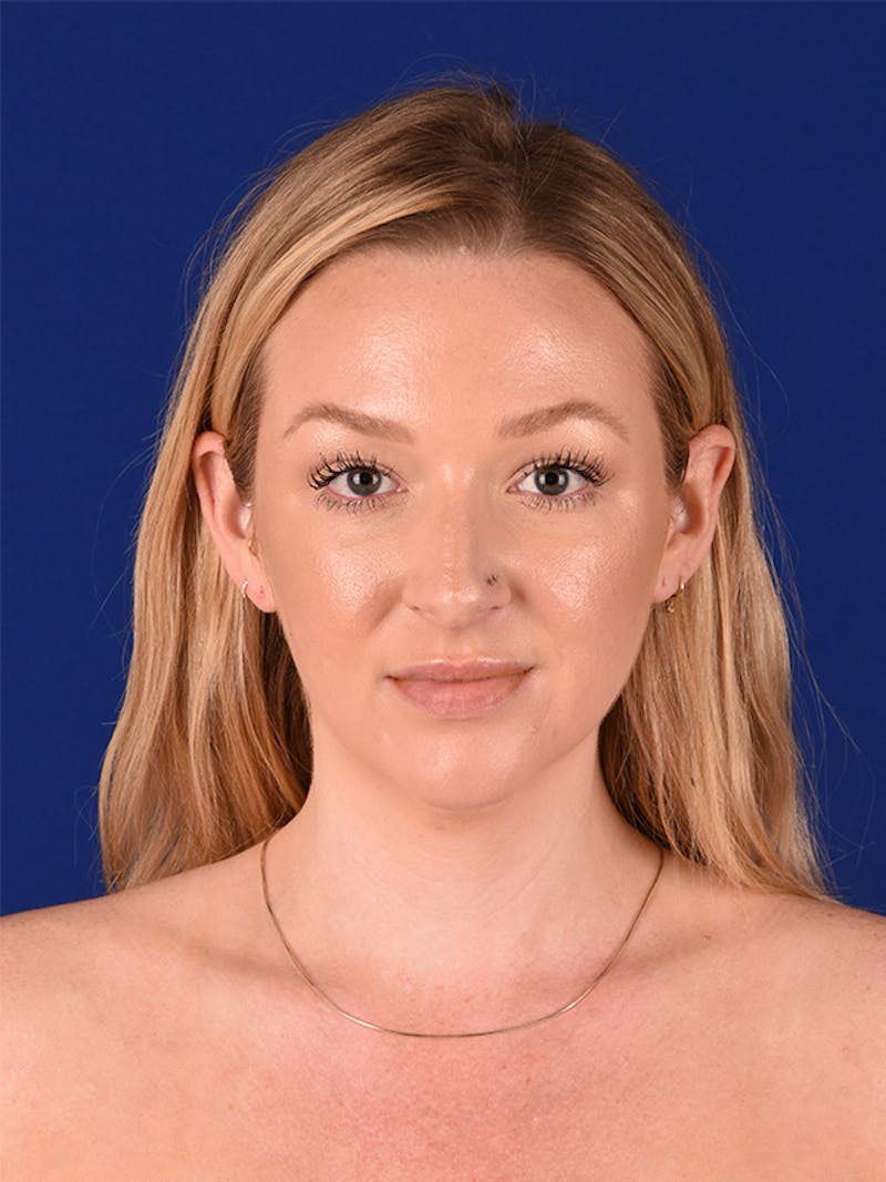 Female Rhinoplasty Before & After Gallery - Patient 122145251 - Image 1