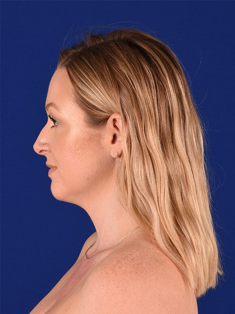 Female Rhinoplasty Before & After Gallery - Patient 122145251 - Image 5