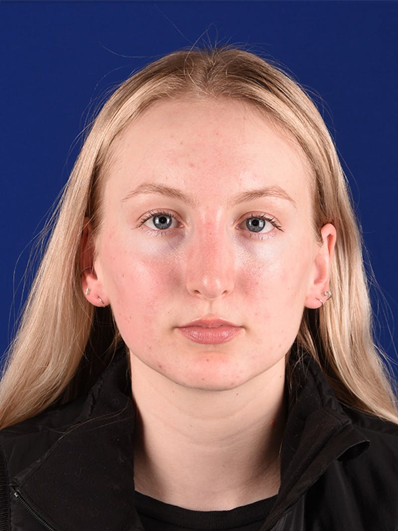 Female Rhinoplasty Before & After Gallery - Patient 122145370 - Image 2