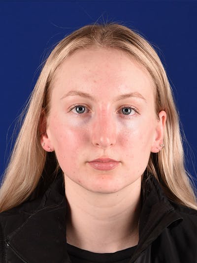 Female Rhinoplasty Before & After Gallery - Patient 122145370 - Image 2