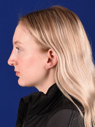 Female Rhinoplasty Before & After Gallery - Patient 122145370 - Image 6
