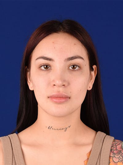 Female Rhinoplasty Before & After Gallery - Patient 122145368 - Image 2