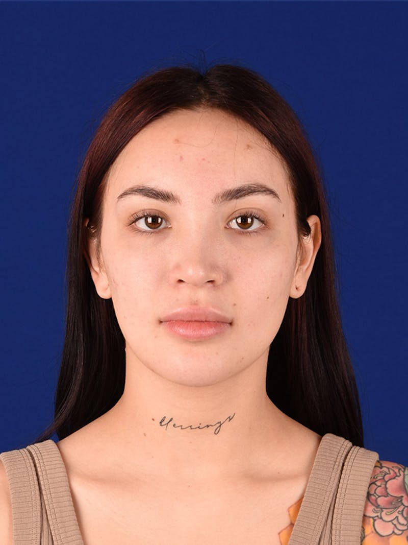Female Rhinoplasty Before & After Gallery - Patient 122145368 - Image 2