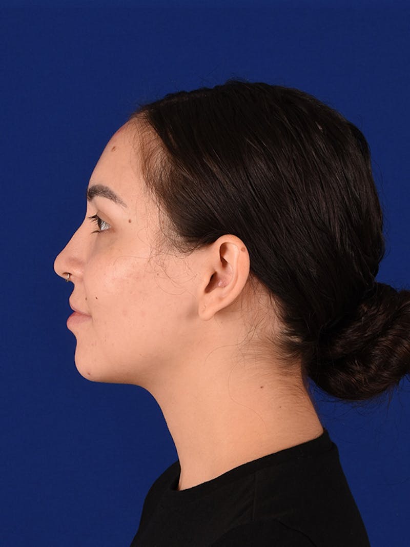 Female Rhinoplasty Before & After Gallery - Patient 122145368 - Image 5