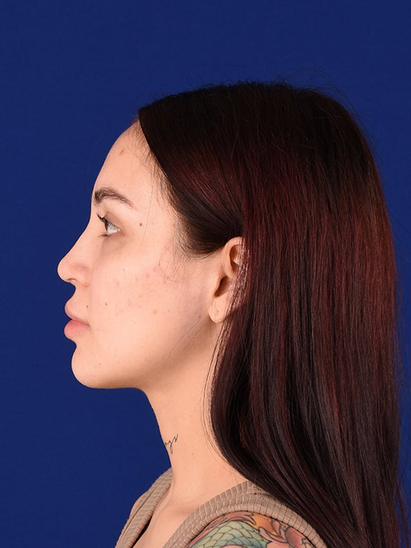 Female Rhinoplasty Before & After Gallery - Patient 122145368 - Image 6